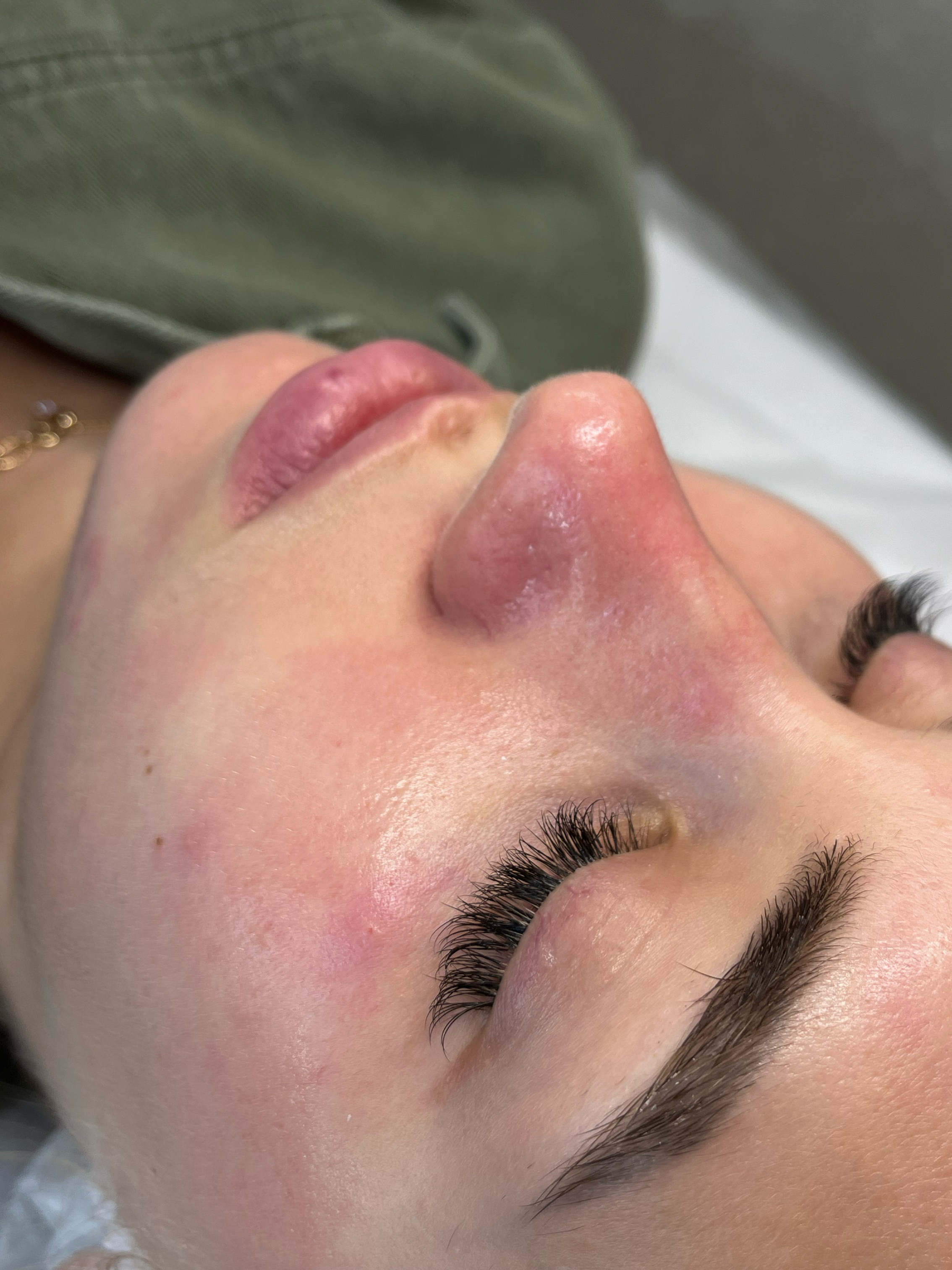 Skin Reset